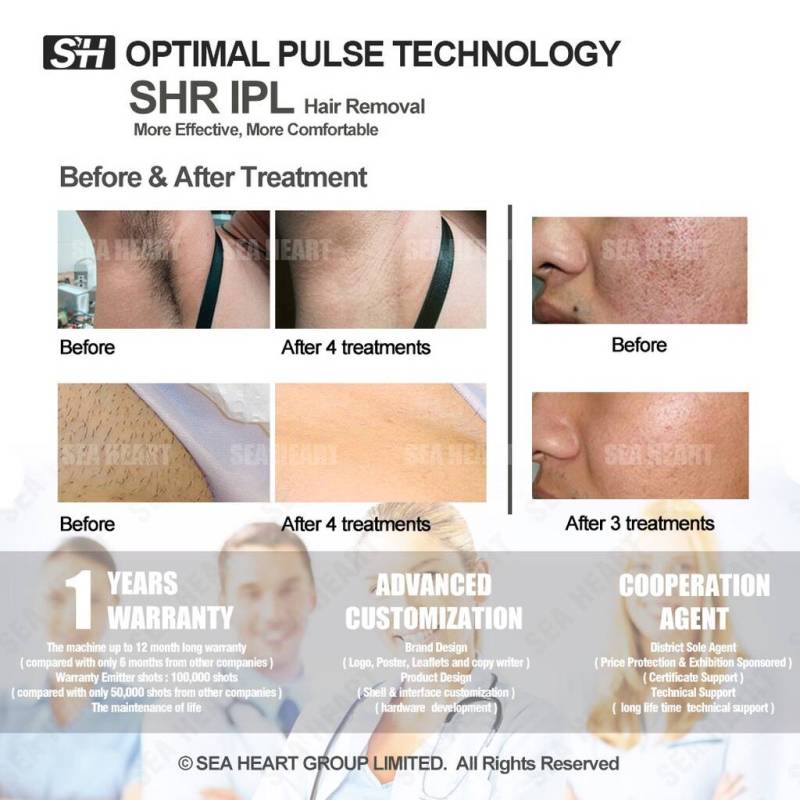 Non - invasive skin treatment intense pulse light permanent super hair removal shr ipl machine