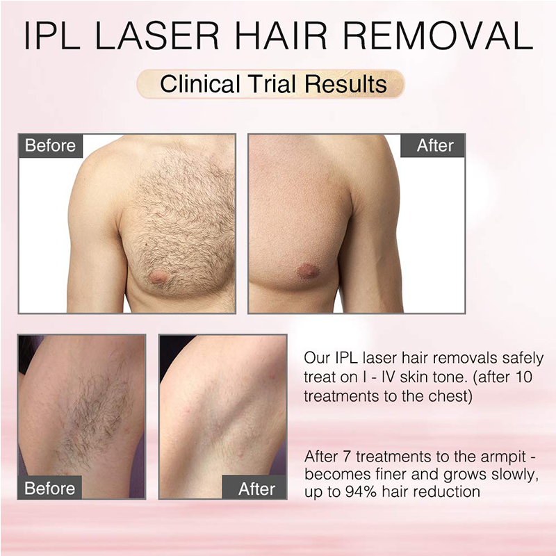 IPL Machine Laser Beauty Equipment