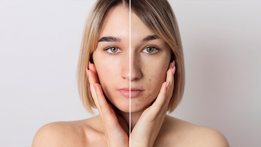 How to Cover Acne with Makeup