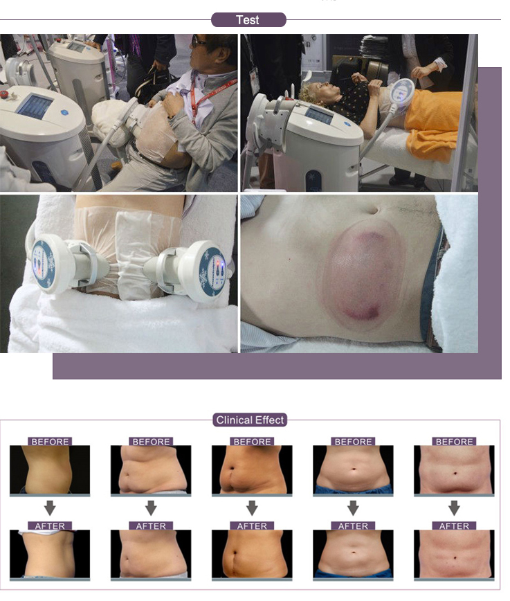 Freeze sculptor cryolipolysis cellulite reduction and loss weight machine