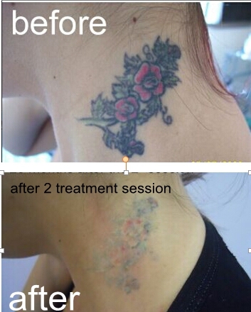 Nano laser Q-switch tattoo removal & skin rejuvenation 
