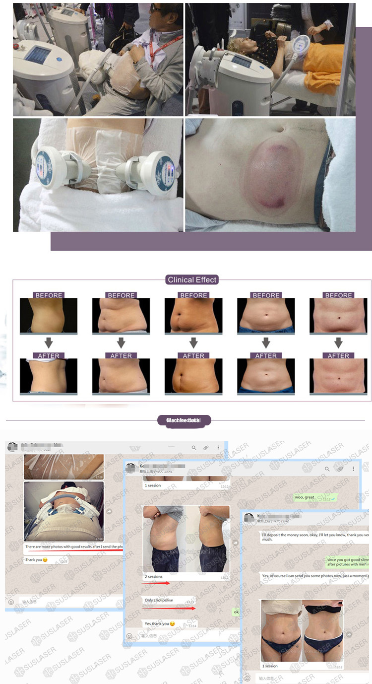 High quality Freeze sculptor cryolipolysis cellulite reduction and loss weight machine 
